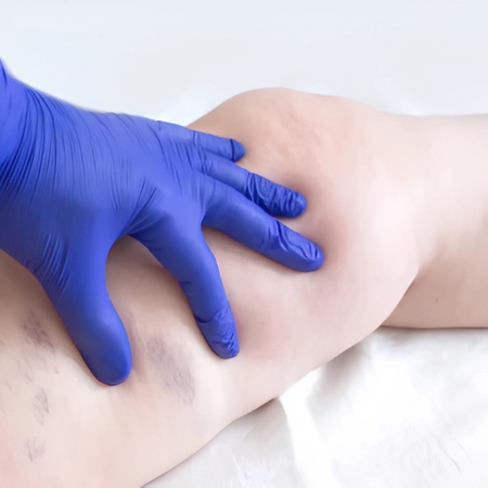 Ozonoterapia para úlceras varicosas